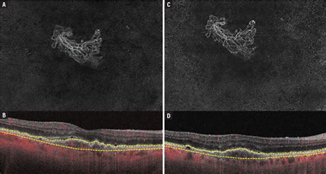 Clinical Utility of OCT Angiography for AMD - Retina Today