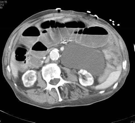 Mesenteric Cyst - Small Bowel Case Studies - CTisus CT Scanning