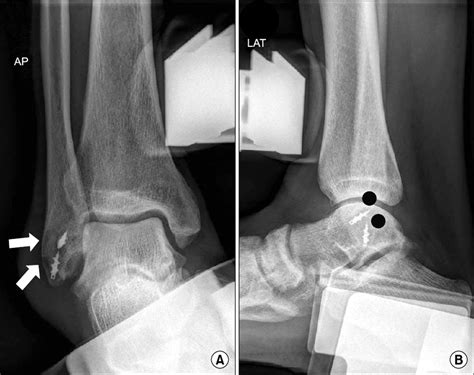 (A) Postoperative stress radiograph shows the varus stability of ankle... | Download Scientific ...