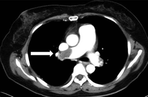 Chest CT angiography shows acute pulmonary embolism (ar | Open-i