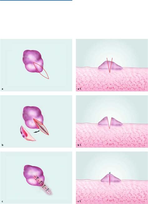 11.4 Incisional Biopsy