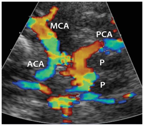 AIUM Practice Guideline for the Performance of a Transcranial Doppler Ultrasound Examination for ...