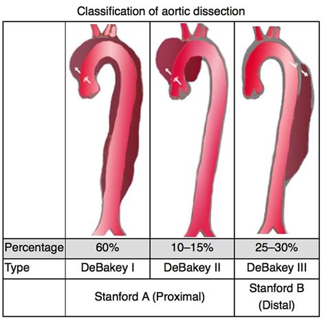 Aortic Dissection - Type A And B - Symptoms, Causes, Treatment