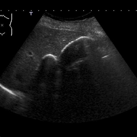 Porcelain Gallbladder Ultrasound