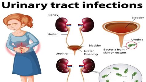 7 Actionable Urinary Tract Infection Treatment Tips That Work Like a Charm - DeepAdvices