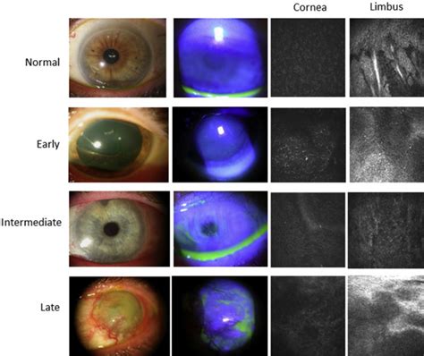 Limbal Basal Cell Density Decreases in Limbal Stem Cell Deficiency | Ento Key