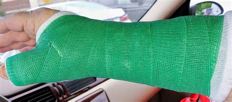 Scaphoid fracture thumb cast in 2022 | Arm warmers, Leg warmers, Fingerless