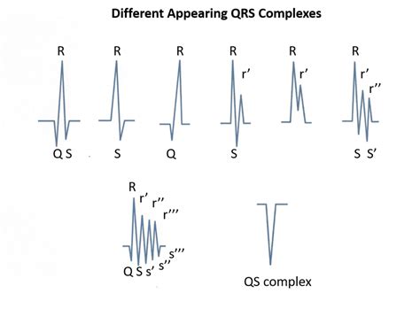 What Is An rSR Prime (rSR') Pattern On An ECG? | Executive ...