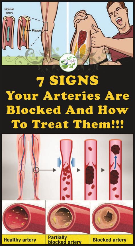 7 Signs Your Arteries Are Blocked And How To Treat Them!!! #arteries #health | Natural health ...