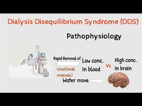 What is Dialysis Disequilibrium syndrome {DDS} | Hemodialysis ...