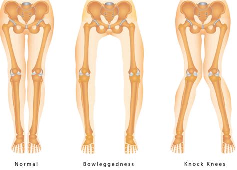 Knock knees causes, signs, symptoms, diagnosis & knock knees treatment