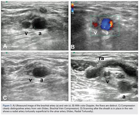 Arterial Ultrasound