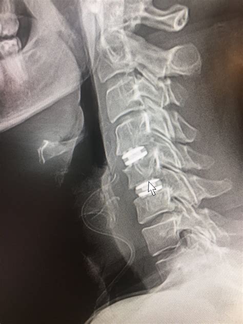 Cervical Artificial Disc Replacement (ADR) Vs. Anterior Cervical ...