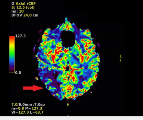 MRI perfusion demonstrating decreased cerebral blood flow in the ...