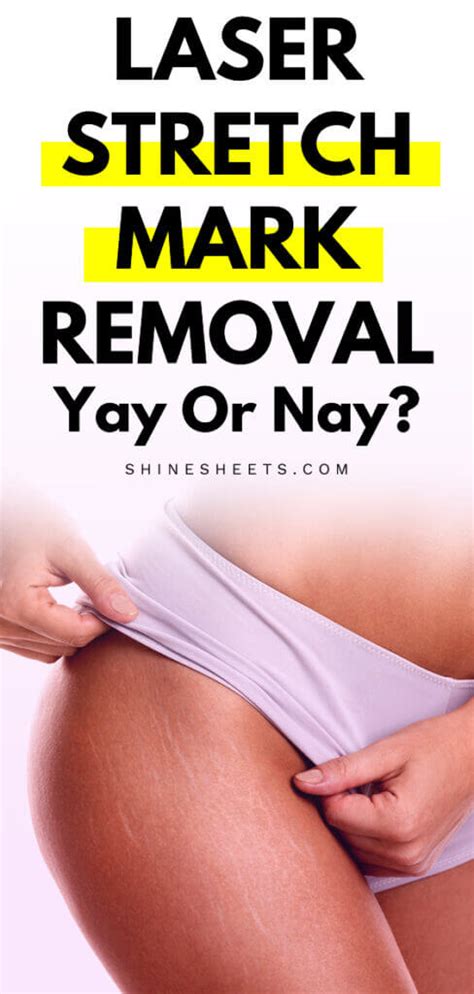 Laser Stretch Mark Removal - Yay Or Nay?