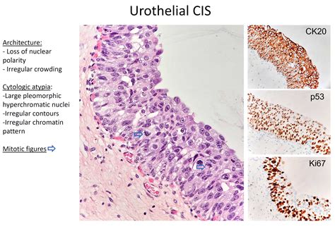 Penile Carcinoma In Situ Wikidoc, 51% OFF