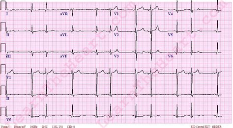 Atrial Bigeminy ECG | LearntheHeart.com