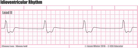 ECG Educator Blog : Idioventricular Rhythm