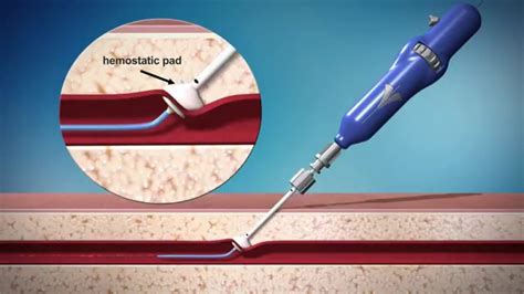 VascuClose XP vascular closure device | Vascular, Health economics ...