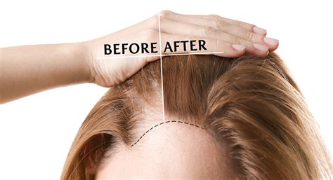 Best Ayurvedic Treatments for Hair Growth - SureShot Ayurveda