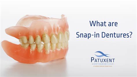 What are Snap-in Dentures? - Patuxent Orthodontics