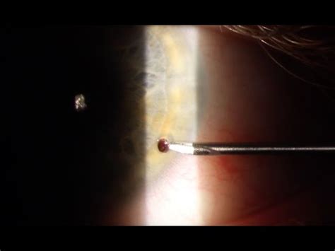 Corneal Foreign Body Removal - YouTube