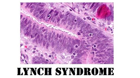 Lynch Syndrome: Definition, Causes, 4 Symptoms, Complications, And When ...