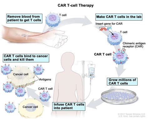 T-cell Transfer Therapy - Immunotherapy - NCI