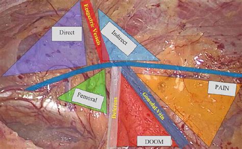 Transabdominal Preperitoneal (TAPP) Inguinal Hernia Repair | IntechOpen