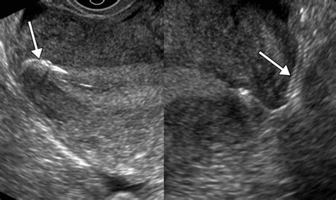 Essure Ultrasound