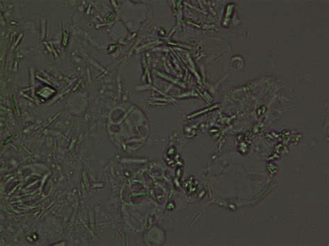 Identification of Intracellular Vacuoles in Synovial Fluid with Calcium ...