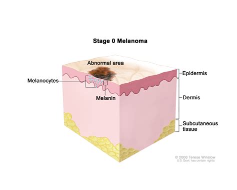 stage 0 melanoma (Patient) - Siteman Cancer Center