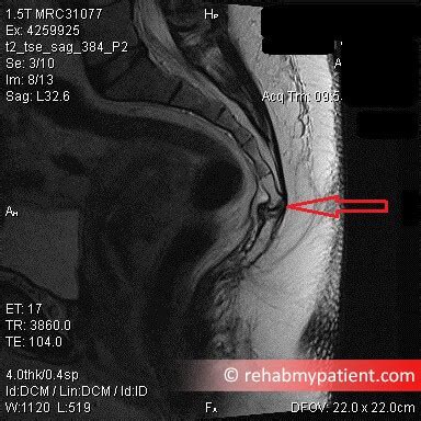 Coccyx Fracture | Rehab My Patient