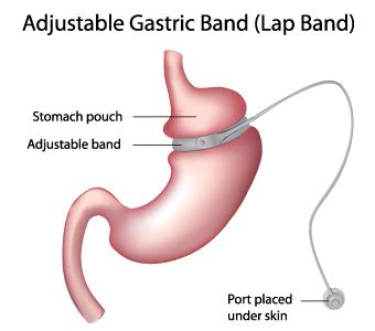 Laparoscopic Adjustable Band (Lap-Band) | UI Health