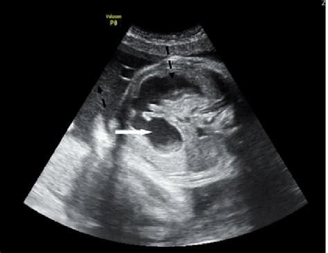 Prenatal B-mode transverse ultrasound of the fetal abdomen showing two... | Download Scientific ...