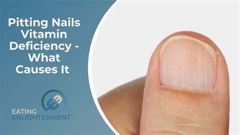 Pitting Nails Vitamin Deficiency: What Causes It — Eating Enlightenment