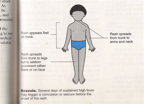 THE HOME TREATMENT: Home Treatment For Roseola