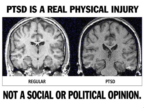 PTSD News: Brain shrinkage in Japanese tsunami survivors with PTSD