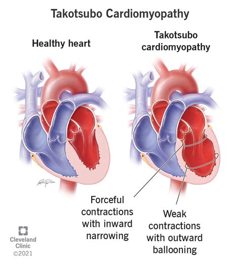 Takotsubo Cardiomyopathy Symptoms Causes Treatment Thehealthsite | The Best Porn Website