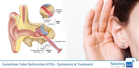 Eustachian Tube Dysfunction (ETD) - Symptoms & Treatment