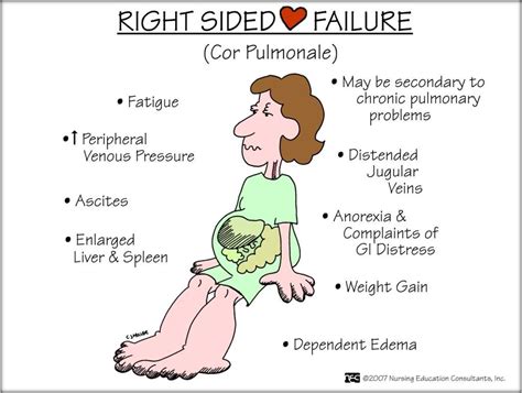 Nursing Mnemonics: Right Sided Heart Failure Nursing School Studying, Nursing School Notes ...