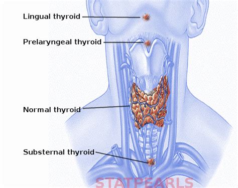 Ectopic Thyroid - StatPearls - NCBI Bookshelf