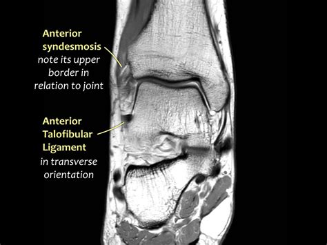 Mri Ankle Anatomy Ligaments