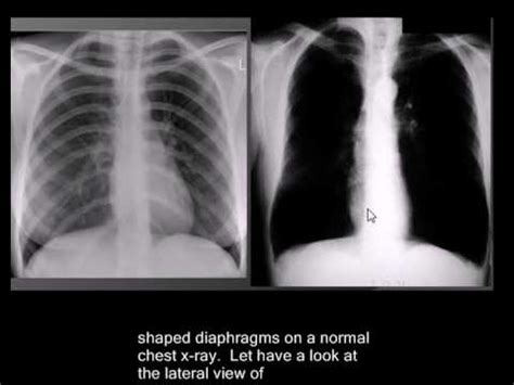 Chest x-ray interpretation -COPD, emphysema - YouTube