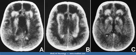 Alexander disease | MedLink Neurology