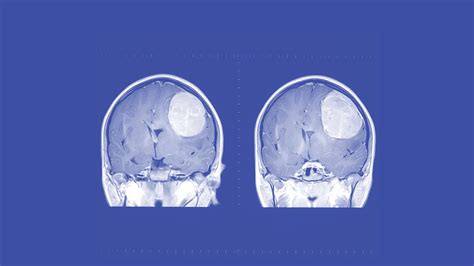 Anaplastic Astrocytoma: Causes, Symptoms, Diagnosis, and Treatment - MDMEDICINE