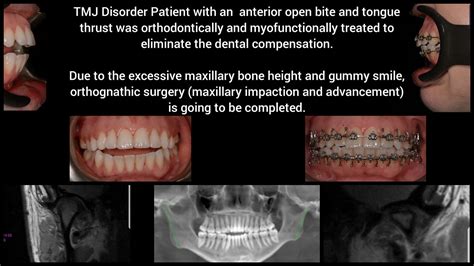 TMJ Disorder Patient with an anterior open bite and tongue thrust was orthodontically and ...