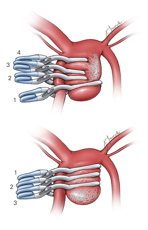 Clip Ligation of Previously Coiled Aneurysm | The Neurosurgical Atlas