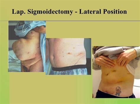 Laparoscopic Sigmoid Colon Resection: Supine and Lateral