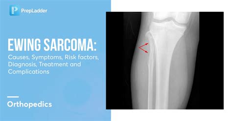 Ewing’s Sarcoma: Causes, Symptoms, Risk Factors, Diagnosis, Treatment and Complications